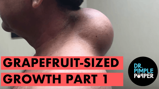 Grapefruit Sized Growth (Part 1)