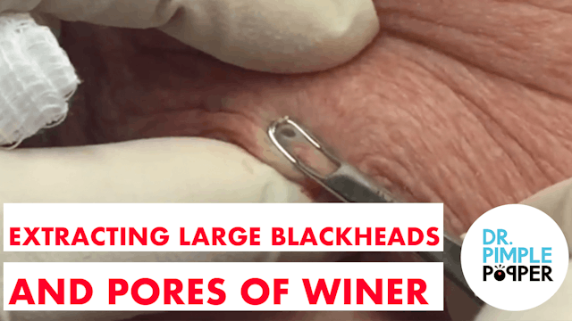 Extracting Large Blackheads and Pores...