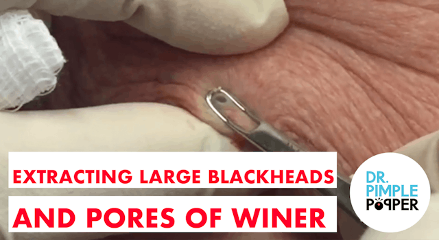 Extracting Large Blackheads and Pores of Winer