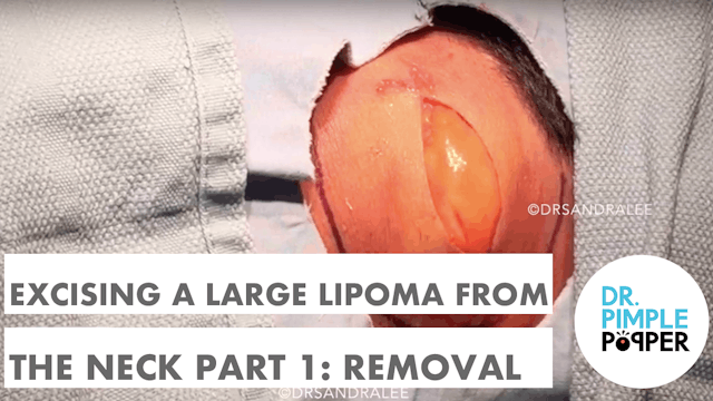 Dr Rebish excising a large lipoma from the neck: Part 1 - Removal