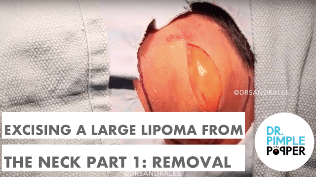 Dr Rebish excising a large lipoma fro...