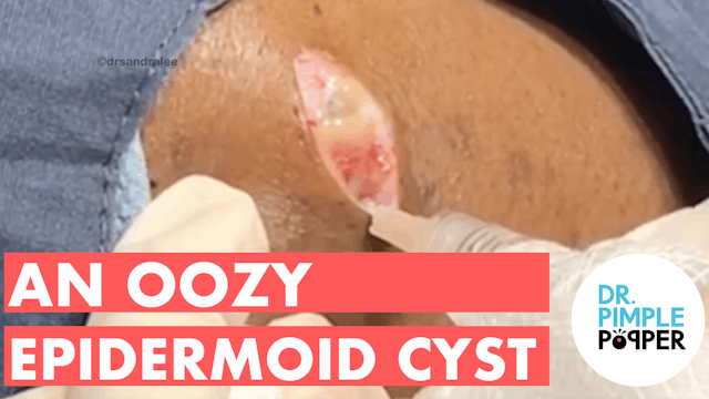 An Oozy Epidermoid Cyst