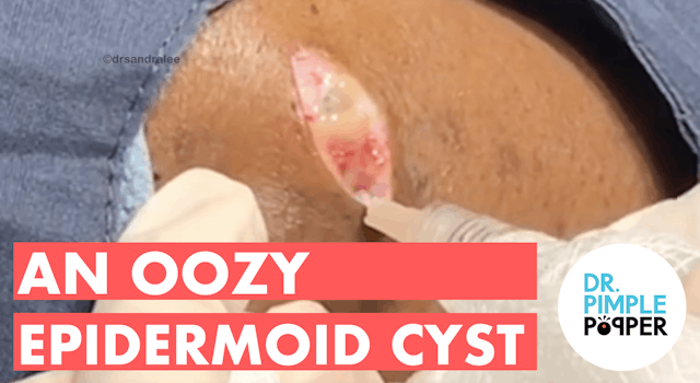 An Oozy Epidermoid Cyst