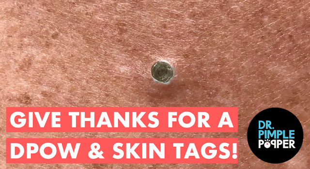 Give Thanks for a DPOW & Skin Tags!