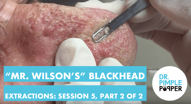 "Mr Wilson's" blackhead extractions, ...