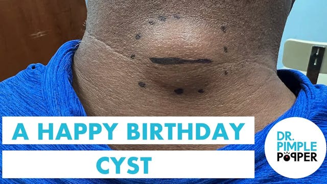 A Birthday Cake Cyst