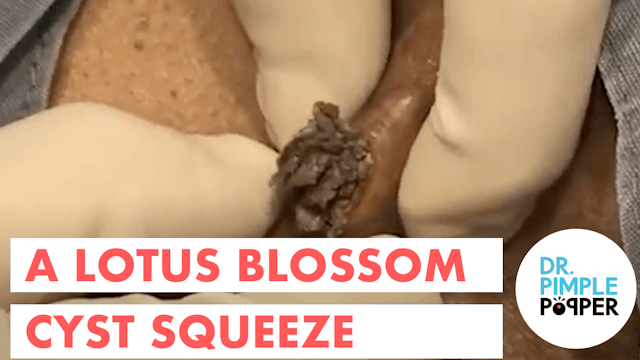 A Lotus Flower Blossom Cyst Squeeze