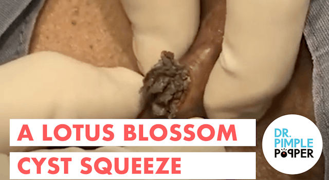 A Lotus Flower Blossom Cyst Squeeze