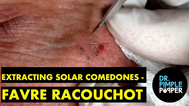 Extracting Solar Comedones - Favre Racouchot