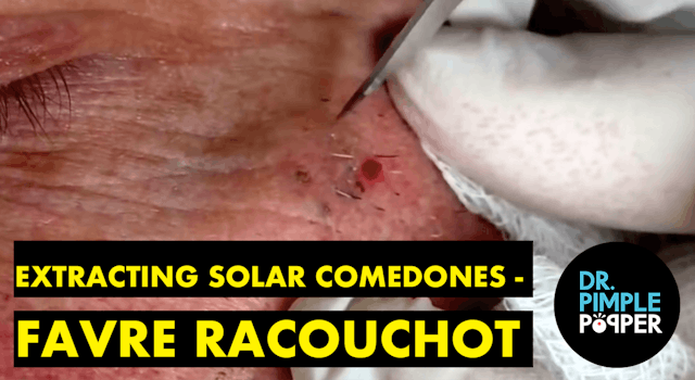 Extracting Solar Comedones - Favre Ra...