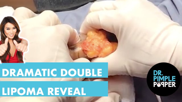 A Dramatic Double Lipoma Reveal