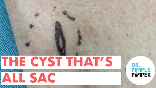 The Cyst That's ALL Sac