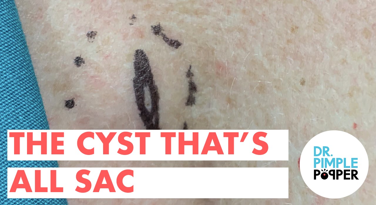 The Cyst Thats All Sac Cystactular Cysts Dr Pimple Popper