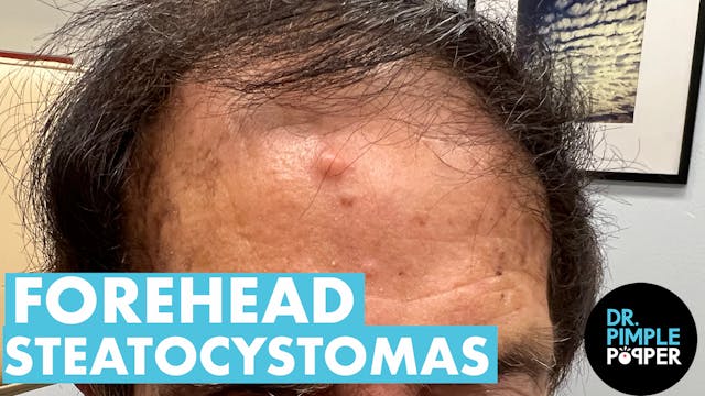 Extracting Forehead Steatocytomas! Pa...