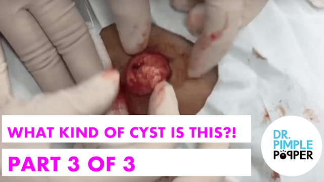 What kind of Cyst is This?! Part 3 of 3