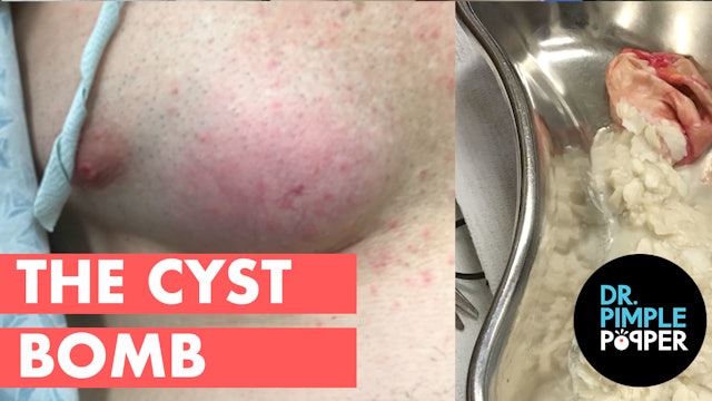 The Cyst Bomb