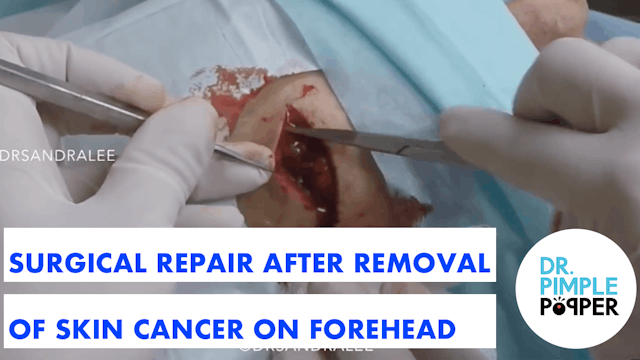 Dermatology: Surgical Repair after Removal of a Skin Cancer on the Forehead