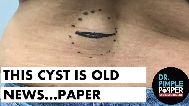 This Cyst is Old News...Paper