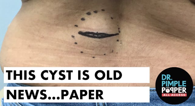 This Cyst is Old News...Paper