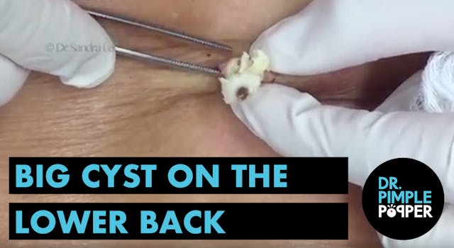 BIG cyst on lower back!