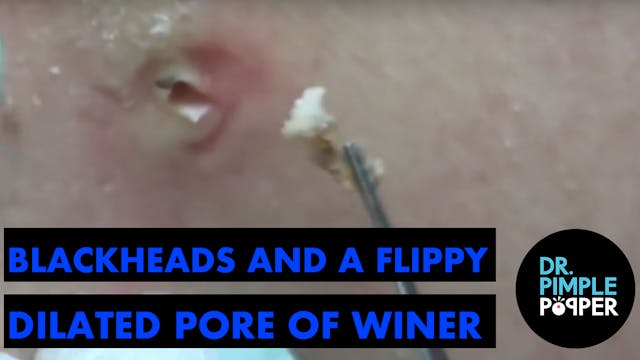 Blackheads and a Flippy Dilated Pore ...