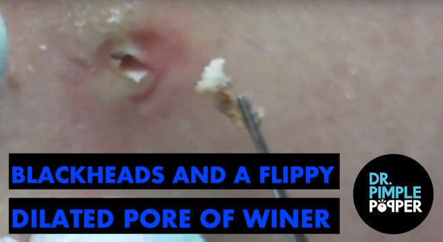 Blackheads and a Flippy Dilated Pore of Winer