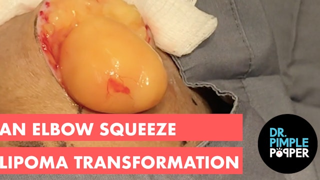 An Elbow Squeeze Lipoma Transformation