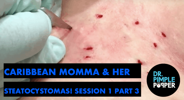 Caribbean Momma and her Steatocystomas: Session One, Part Three