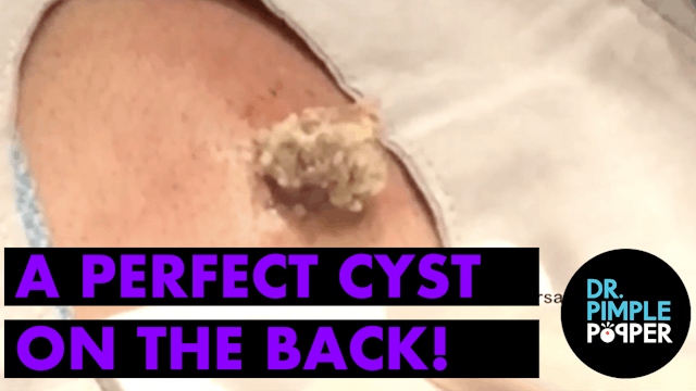 A perfect Cyst on the back, right whe...