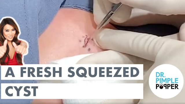 A Fresh Squeezed Cyst