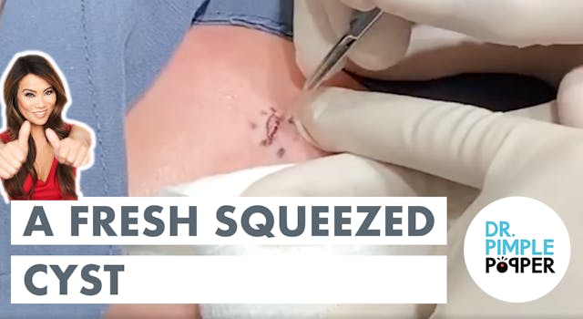 A Fresh Squeezed Cyst