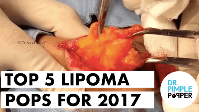 Dr Pimple Popper's Top 5 Lipoma POPS for 2017
