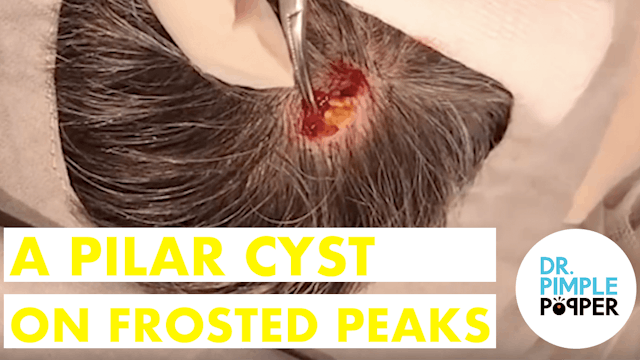 A Pilar Cyst on Frosted Peaks