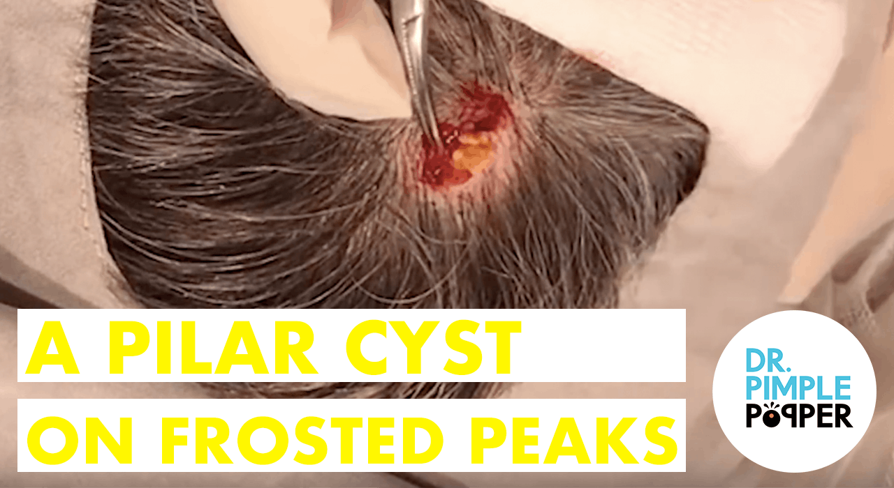 the-gigantic-pilar-cyst-what-s-inside-youtube