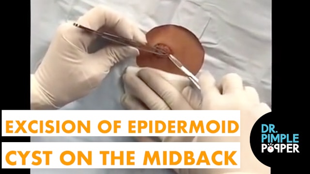 Excision of an Epidermoid Cyst on the Midback