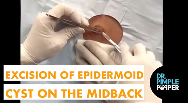 Excision of an Epidermoid Cyst on the...