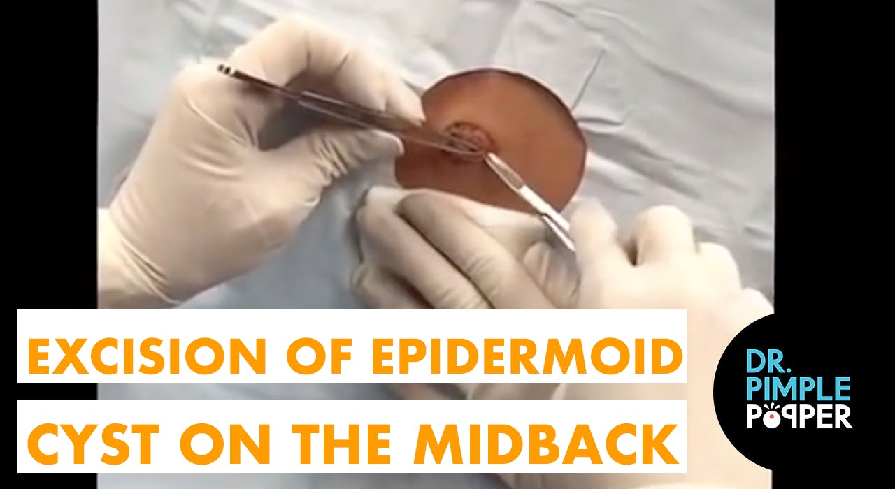 Excision Of An Epidermoid Cyst On The Midback Dr Pimple Popper