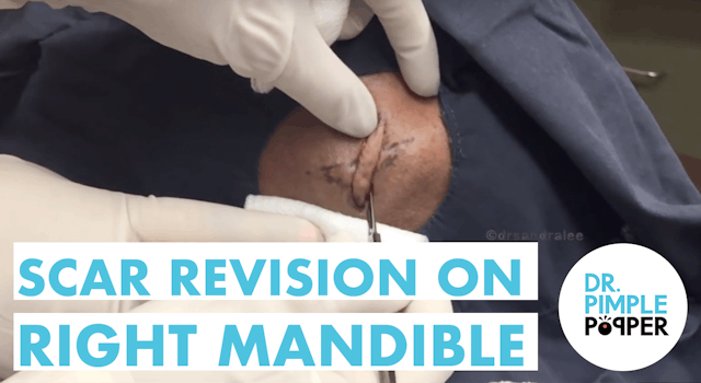 A Scar Revision on the Mandible