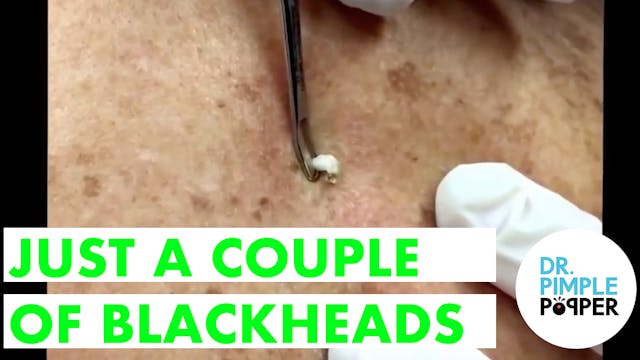 Just a couple of blackheads but one's...
