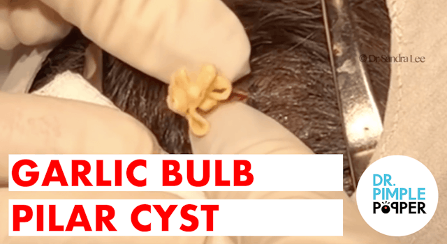 Garlic Bulb Pilar Cyst