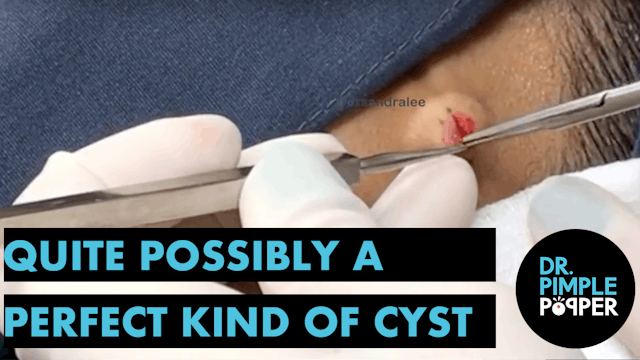 Quite possibly a Perfect Kind of Cyst