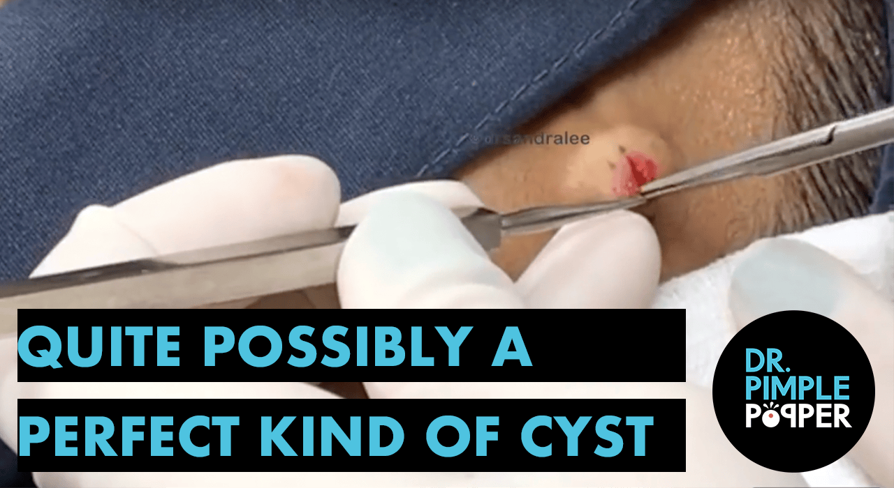 Quite possibly a Perfect Kind of Cyst Dr. Pimple Popper