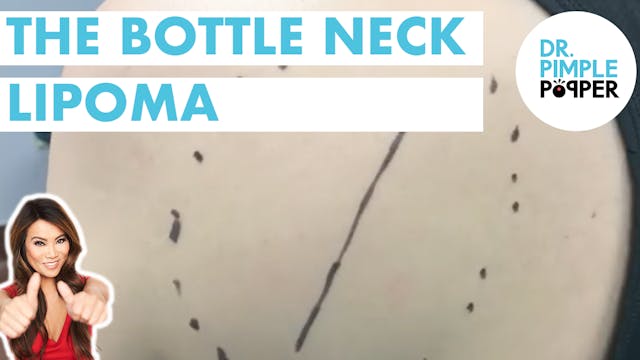 The Bottle Neck Lipoma