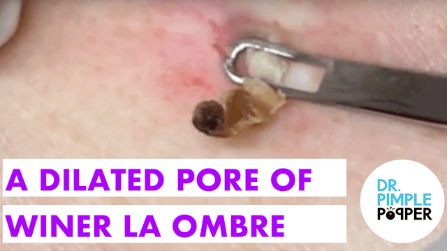 A Dilated Pore of Winer a la Ombre´