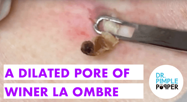 A Dilated Pore of Winer a la Ombre´