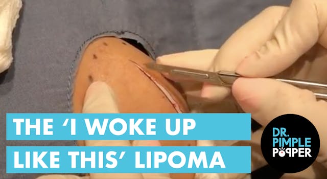 The "I Woke Up Like This" Lipoma