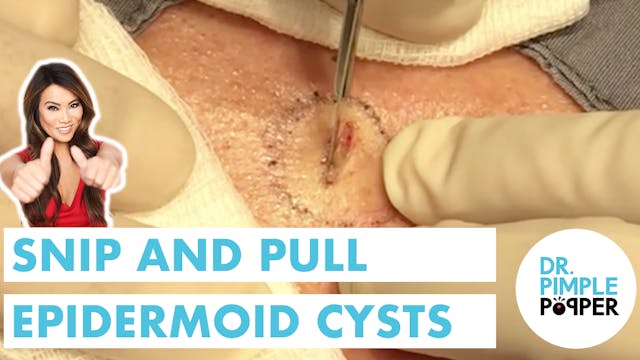 Snip & Pull Epidermoid Cysts (x3)