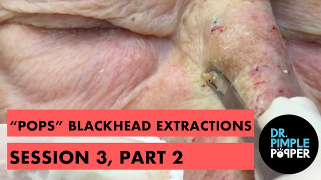 "Pops" blackhead extractions session ...