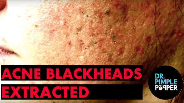 Acne & Blackheads extracted by Dr. Sandra Lee