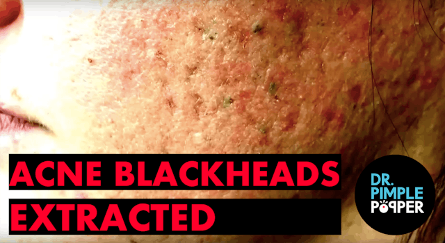 Acne & Blackheads extracted by Dr. Sa...